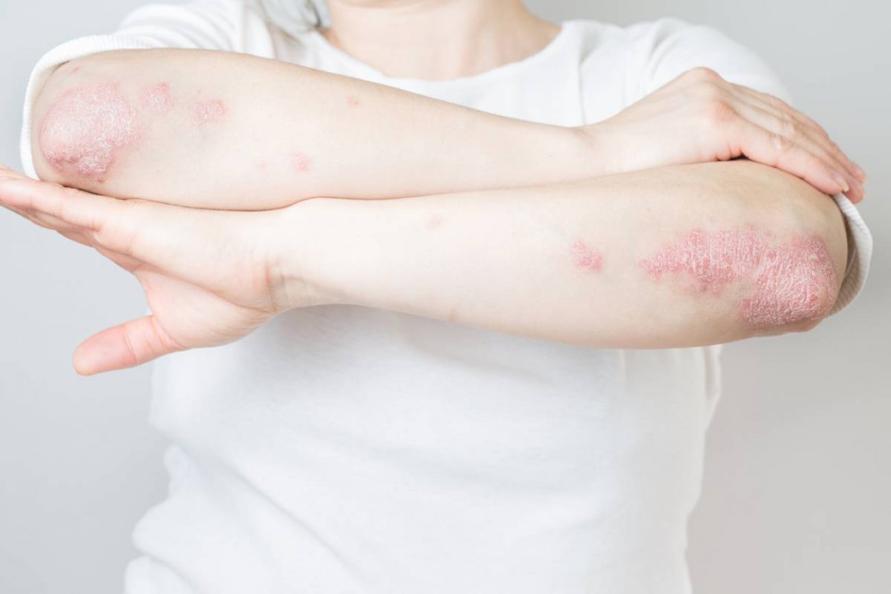 Visitez LM Natura : solutions naturelles de traitement du psoriasis